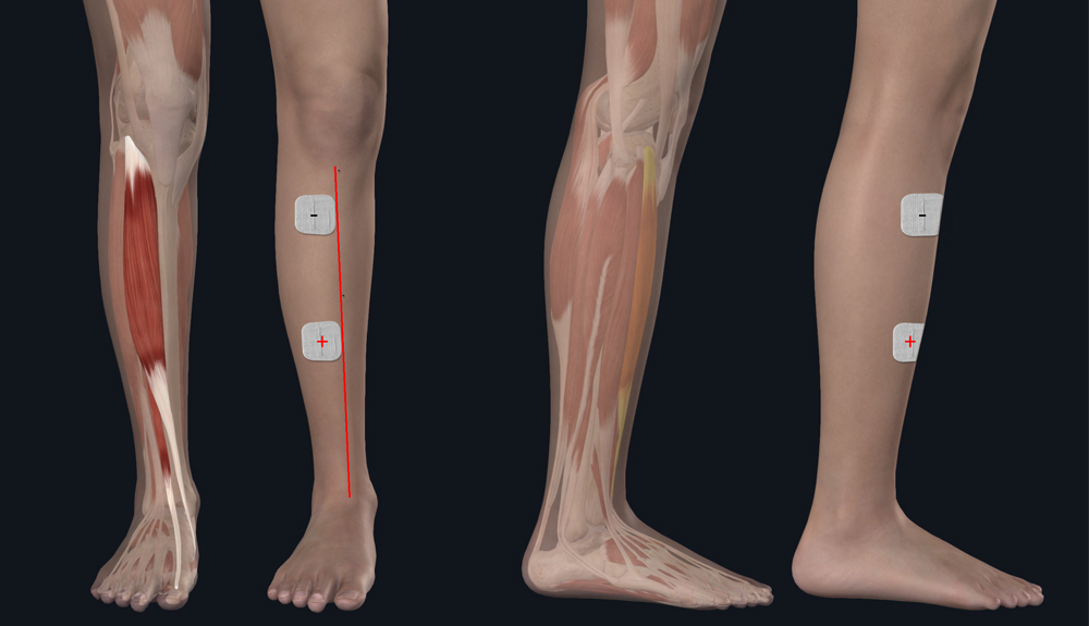 elektrodeplaatsingspunten bij peroneusparesis