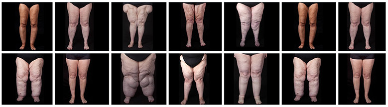 lipoedeem-lymfoedeem